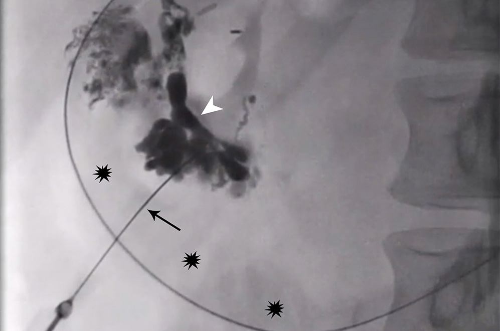 Fluoroscopic image of n-BCA glue injection into the periduodenal mass